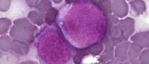 leukemia_cells1-668x288